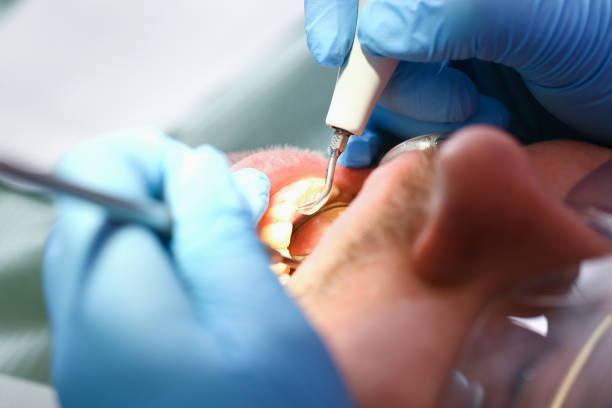 Best Emergency Tooth Extraction in Polkton, NC